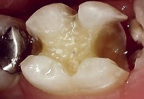 口腔内カメラで見た歯